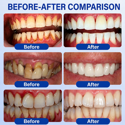 💥🦷𝐇𝐈𝐒𝐊𝐈𝐍®  👩‍⚕️ Targeted Gum Repair Advanced Overnight Precision Gel Pen 🌙